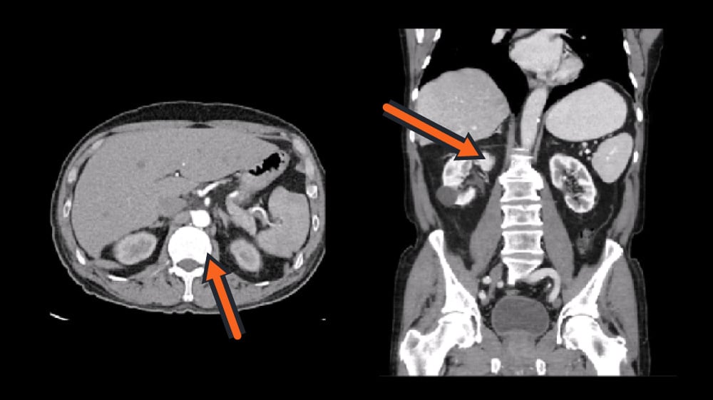 Two CT scan views of the abdomen with orange arrows pointing to anatomical structures.